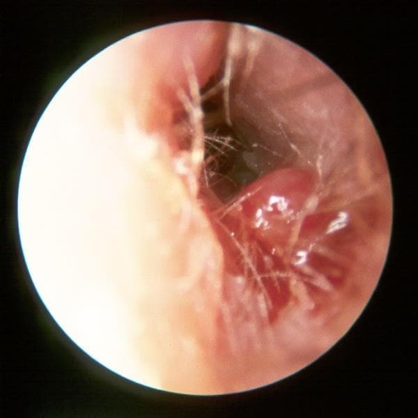 Figure 3: Necrotising (malignant) otitis externa
